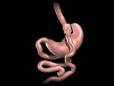 Animated Gastric Bypass Procedure