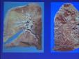 Diagnosis 101: How We Approach Patients with Pulmonary Fibrosis - Andrew Chan, MD