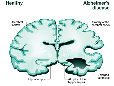 The Impact of Seizures on Alzheimer's Disease